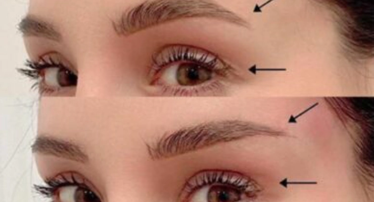  من هم المرشحين المناسبين لعملية رفع الحاجب الصدغي؟  
