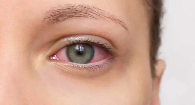 التهاب القزحية