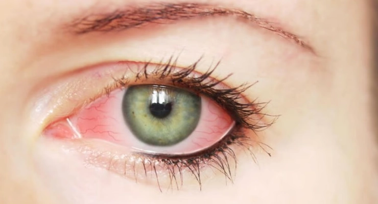 أسباب التهاب القزحية