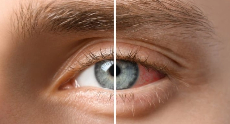 أعراض التهاب القزحية