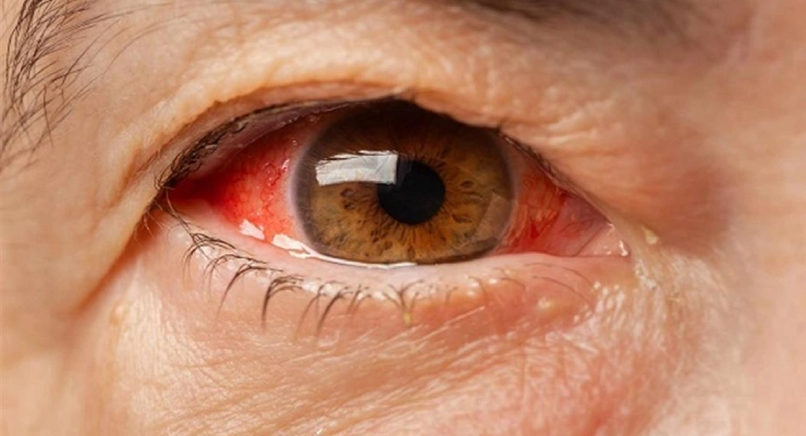 Subconjunctival Hemorrhage
