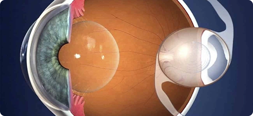 عملية RLE استبدال العدسة الانكسارية أو CLE