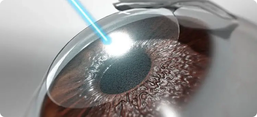 استئصال القرنية اللابؤرية