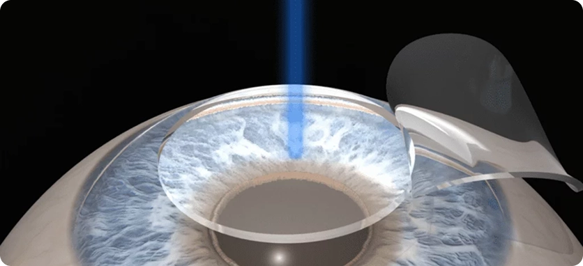 ما هي أمراض الشبكية التي يمكن علاجها بجراحة الليزر؟