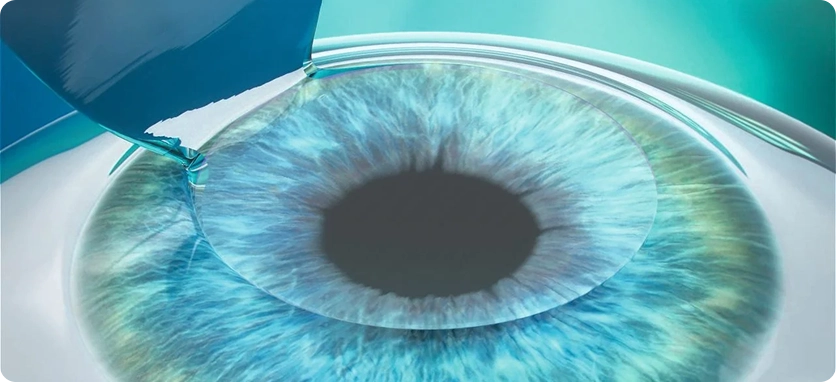 خطوات عملية الفيمتو ليزك