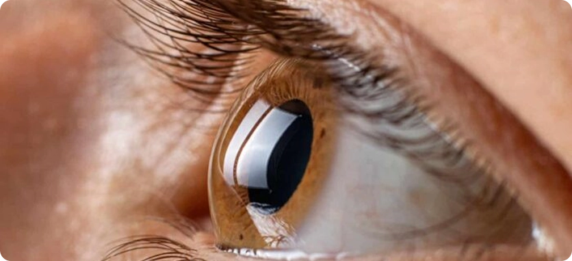 انفصال الشبكية