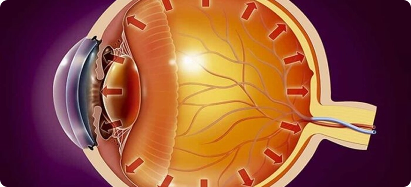 التهاب العصب البصري