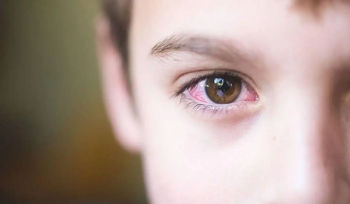 Causes of Red Eyes in Children  