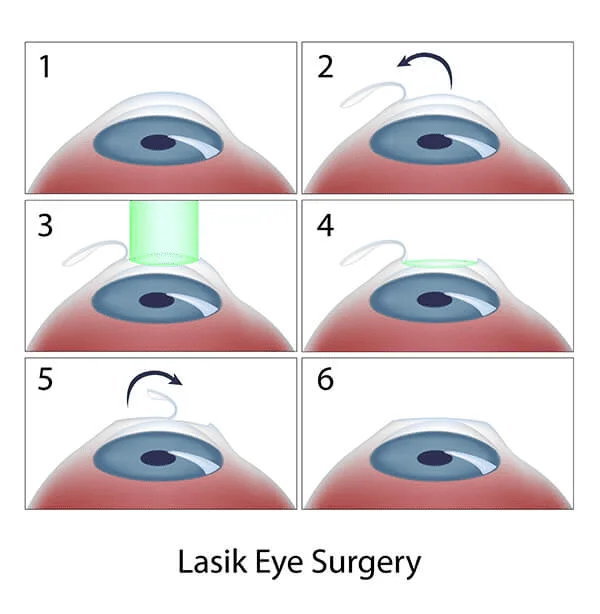 Types of Laser Vision Correction Surgery