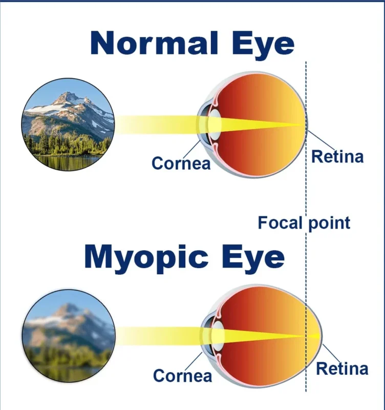 Causes of Myopia