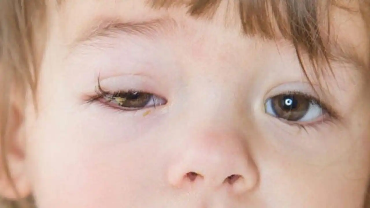 Treatment of Eye Infections in Children at the Clinic