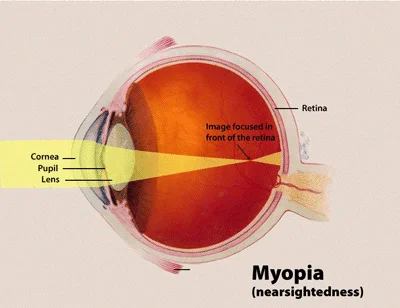 What Does Myopia Mean?