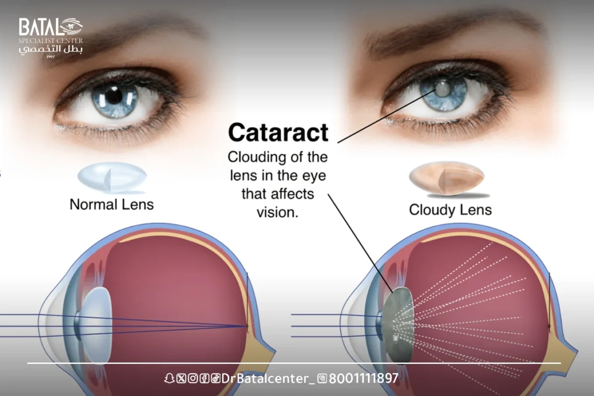 Does Vision Return to 6/6 After LASIK Surgery?