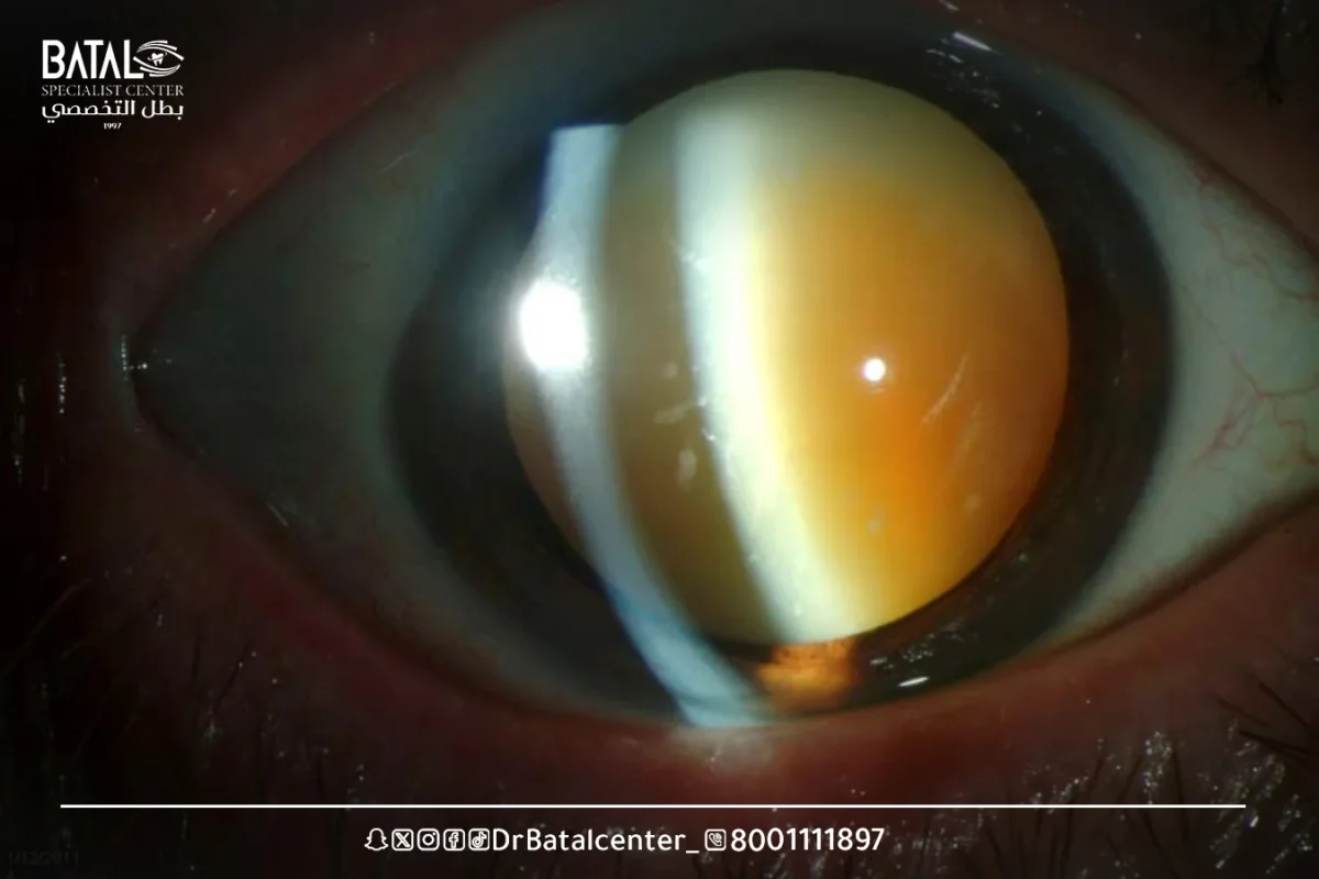 Factors That Affect Whether Vision Returns to 6/6 After LASIK