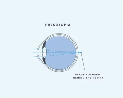 What Is Presbyopia?