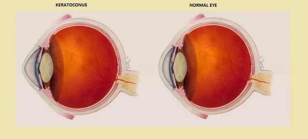 What Is Keratoconus?