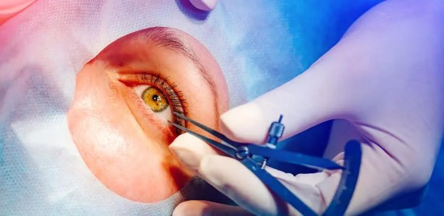 Most Common Questions About Surface Laser Vision Correction