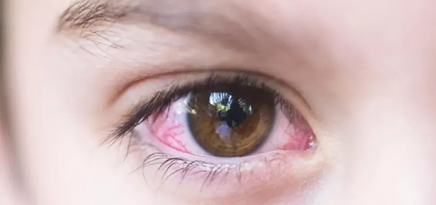 أسباب التهاب العين المتكرر عند الأطفال