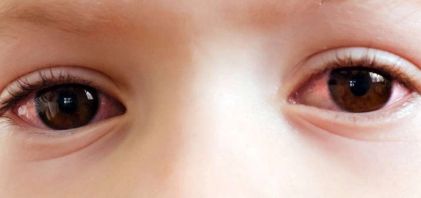علاج التهاب العين المتكرر عند الأطفال