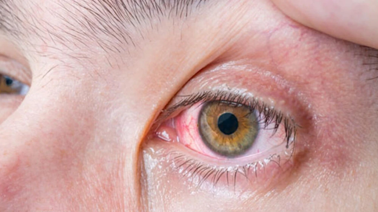 علاج القناة الدمعية