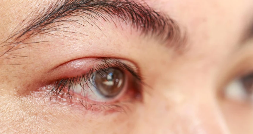 أهم الأعراض التي تستدعي زيارة دكتور القناة الدمعية في ينبع